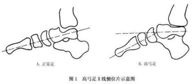 常见的足部畸形 高弓足 