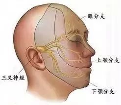 病例 手术治愈左侧桥小脑角表皮样囊肿致三叉神经痛一例 