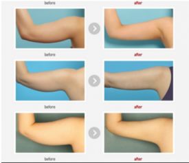 韩国来福琳3step手臂吸脂手术VS普通吸脂,真人案例对比看赢点在哪里