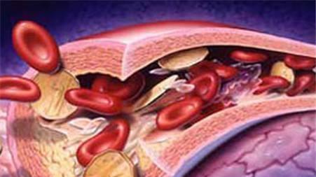 血栓是拖出来的 身体有6信号,暗示血脂 爆表 ,血液稠如粥