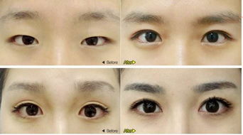 韩式双眼皮适合于哪些人