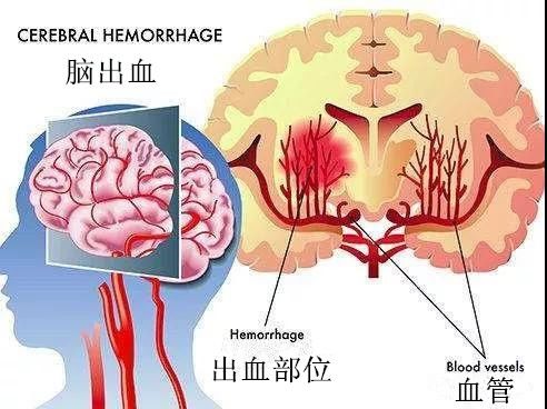 脑梗塞和脑溢血能不能治愈