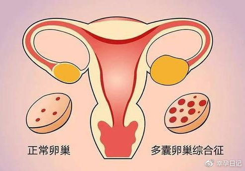 什么是多囊卵巢综合征 怎么分辨自己是否多囊卵巢