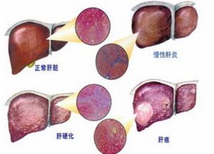 肝硬化失代偿期用药应注意有哪些