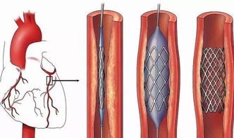心脏支架术后注意这四点可救命 