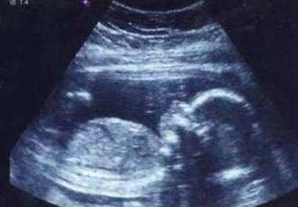 原创孕期，B超单上有3种“情况”，恭喜，可能怀的是孕妈的“小情人”