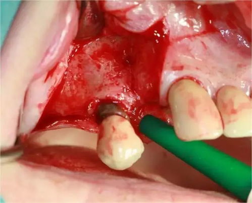14牙位GBR同期种植临床案例一例