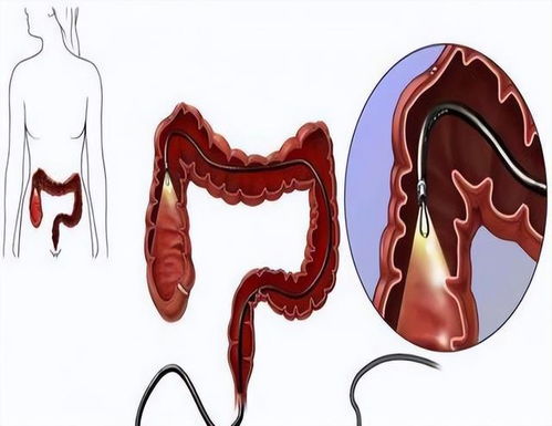 肠道长息肉的原因是什么