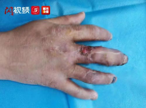 陕西一男子手指被压伤 医生用脚趾给他再造了一根 