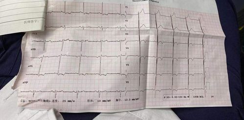 心电图t波改变什么意思 心电图中T波低平或者倒置能反映什么信息？ 