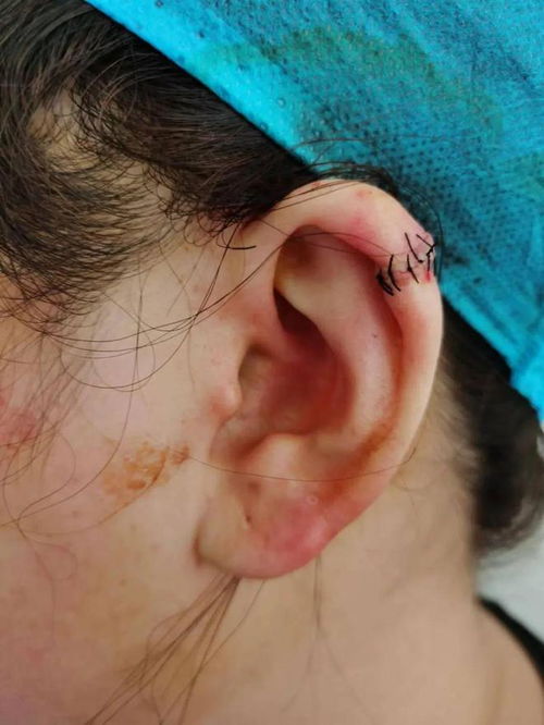 震惊 宁夏26岁女子耳朵长出肉疙瘩 只因在路边打了耳朵眼
