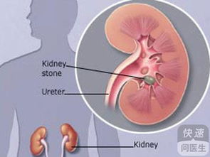 泌尿系结石会复发吗 饮食注意更有预防效果
