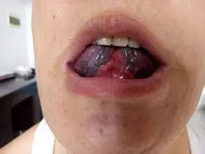 为什么要在舌下取栓 及舌下取栓的主要功效 