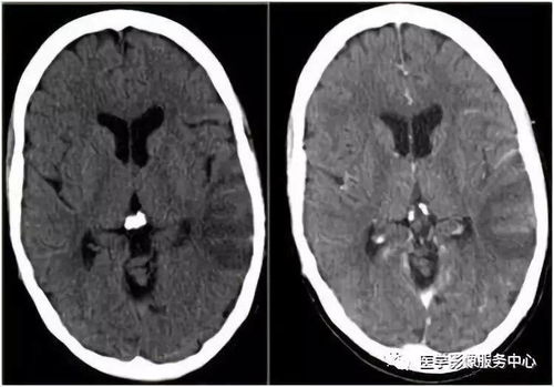 医影学堂 仅用一例脑梗塞病例,就能看出你的诊断水平