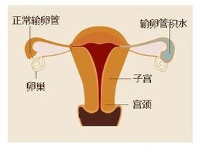 输卵管积液对生育的影响，还能顺利试管移植吗？