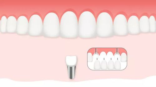 大连齿医生口腔 你的牙齿有变长变宽吗 注意啦 你的牙龈正在萎缩
