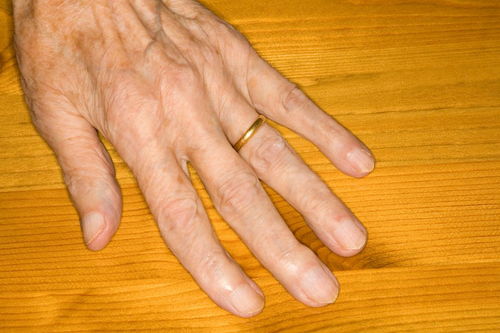 手指头红肿是什么原因引起的 