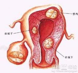 子宫右附件囊肿严重吗(子宫右附件囊肿有哪些症状)