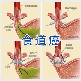 死亡率极高的食道癌,晚期了还能活多久 最终能活几年 