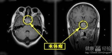 垂体瘤手术步骤