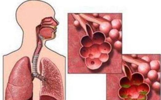 烟抽多了,痰多怎么清肺 医生给出3点建议,早知早受益