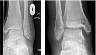 JBJS MRI能准确评估旋后外旋型踝关节骨折的关节稳定性吗 