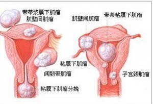 子宫囊肿严重吗有什么危害（子宫囊肿带给女性的伤害有多大）-图1