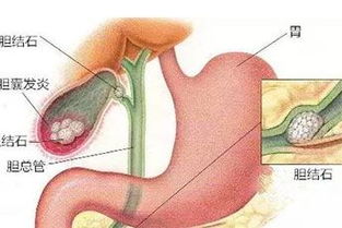 秋泻 来袭 小心你的宝宝出现感染性腹泻