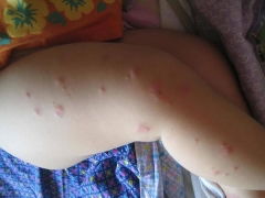 春季出现儿童荨麻疹的原因