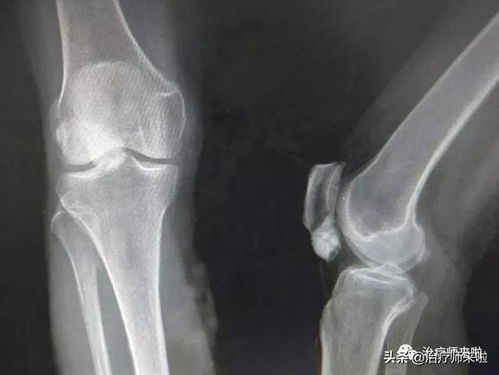 膝盖习惯性脱臼是怎么回事该如何治疗呢(膝盖老脱臼怎么办)
