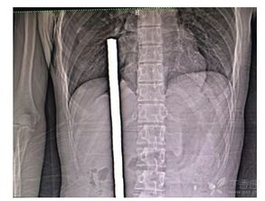 揪心 1米多长钢筋从下体穿入,直逼心脏 浙二各大专家连夜拔除