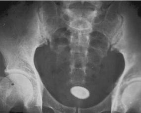 X光片中的膀胱结石 