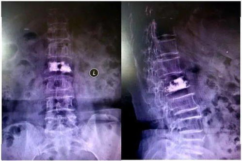 患者福音 区中医院骨质疏松诊断有好仪器,骨质疏松治疗有好技术