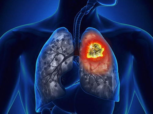 肺结节长到多大会比较危险 医生提醒 出现3种变化的人,要警惕