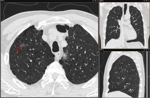 CT发现肺磨玻璃结节,怎么办 来听听影像医生怎么说