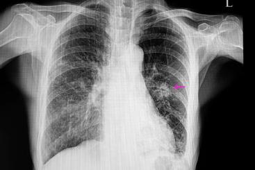 体检发现肺结节,一定是肺癌吗