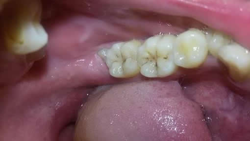 智齿牙龈肿痛怎么办 长智齿引起牙龈肿痛 