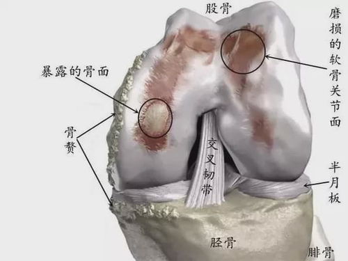 全膝关节置换手术哪些人可以做,哪些人不能做