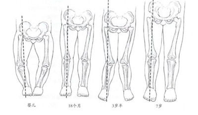小儿 罗圈腿 不可怕,微创治疗有办法 