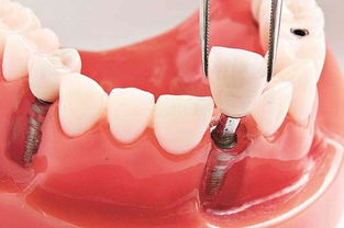 种植牙如何护理 种植牙能用多久