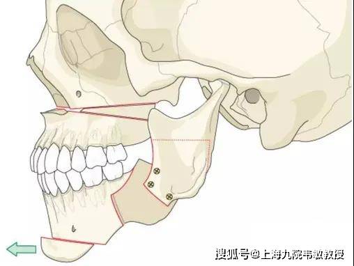 九院韦敏教授丨颏成型与正颌的区别是什么,看这2个方面