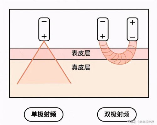 热玛吉间隔多久做一次  第2张