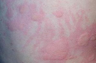 麻疹的主要症状 荨麻疹有什么症状