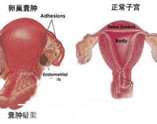 卵巢囊肿可以做试管婴儿吗