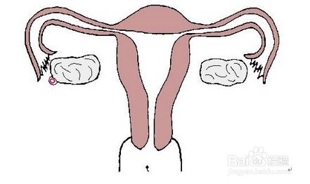 子宫内膜异位性不孕，子宫内膜异位性不孕的病因有哪些