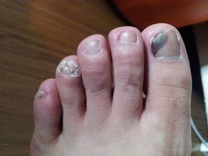 灰指甲危害，灰指甲的危害有哪些