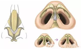 蒜头鼻可以只做鼻尖整形手术不做鼻梁改善吗