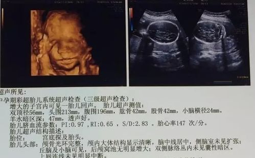 b超单看胎儿性别 从B超单怎样才能看出是男孩还是女孩