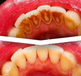 洗牙会导致牙齿松动 关于牙齿的这15个常识你可以知道