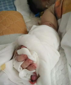心痛 烫伤婴儿住宁波这家医院,被医生剪掉手指